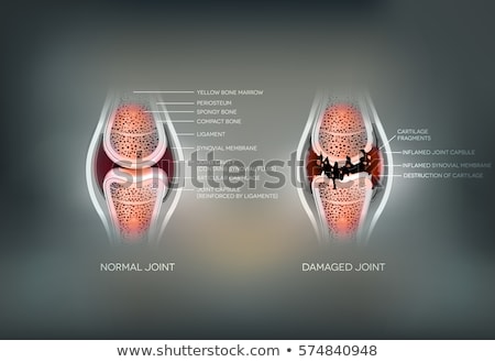 Stock photo: Damaged Joint And Normal Joint Colorful Design On An Abstract Gr