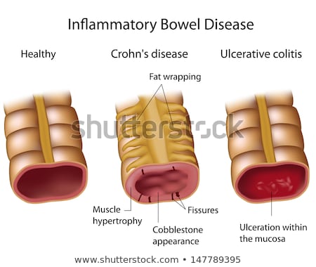 ストックフォト: Crohns Disease Or Crohn Syndrome