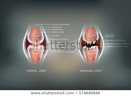 Zdjęcia stock: Damaged Joint And Normal Joint Colorful Design On An Abstract Gr