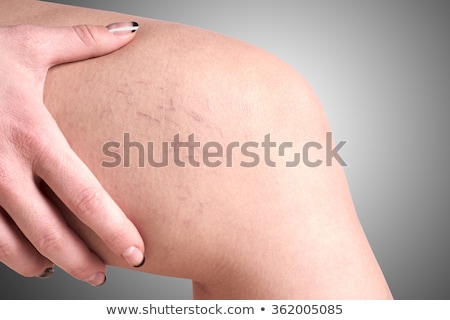 Foto stock: Old Woman With Varicose Veins