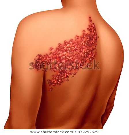 Stok fotoğraf: Diagnosis - Shingles Medical Concept