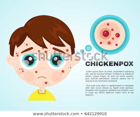 Stock photo: Boy With Chickenpox