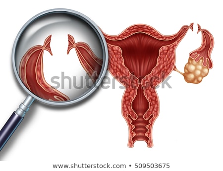 Foto stock: Tubal Ligation