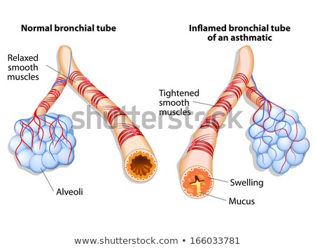 Foto stock: Inflamation Of The Bronchus Causing Asthma