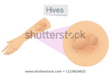 Stock fotó: Magnified Hives On Arm