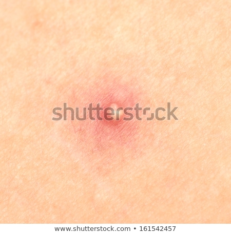 Foto stock: Close Up Of Pimple