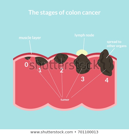Foto d'archivio: The Stages Of Colorectal Cancer