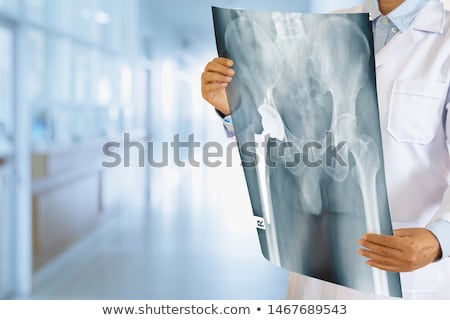Zdjęcia stock: Prosthesis Of The Hip