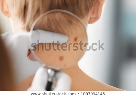 Сток-фото: Melanoma Diagnosis Medical Concept