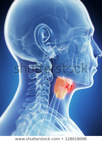 Foto stock: 3d Rendered Illustration Of The Male Larynx - Cancer