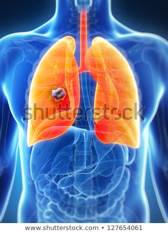 Stockfoto: 3d Rendered Illustration Of The Male Lung - Cancer