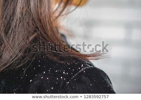 Stock photo: Dandruff On Womans Shoulder