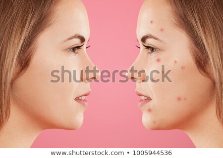 ストックフォト: A Young Woman Having Acne