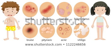 Foto stock: A Human Skin Problem Lichen Planus