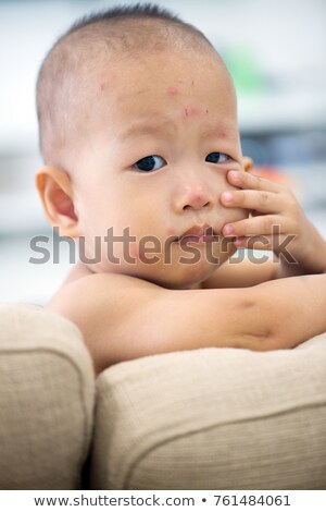Stock photo: Baby Boy With Chicken Pox On Couch