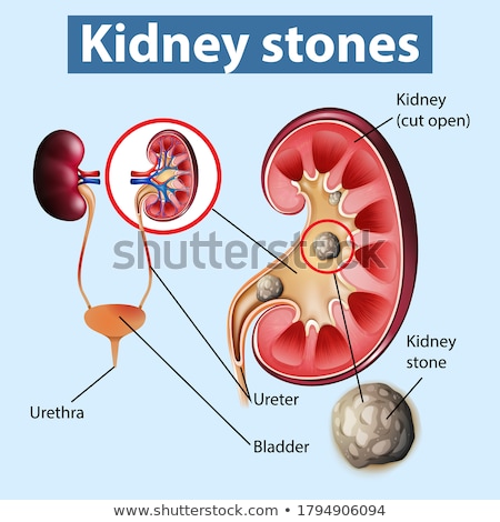 Foto d'archivio: Human Anatomy Diagram With Kidney Stones