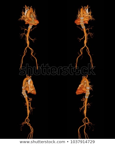 Stok fotoğraf: Stent Coronary Placement