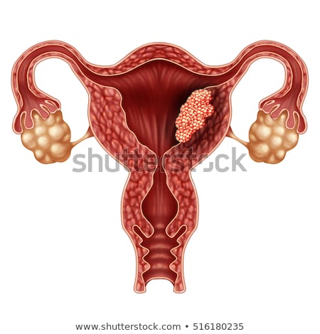 ストックフォト: Endometrial Cancer