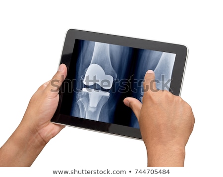 Stok fotoğraf: Osteoporosis On The Display Of Medical Tablet