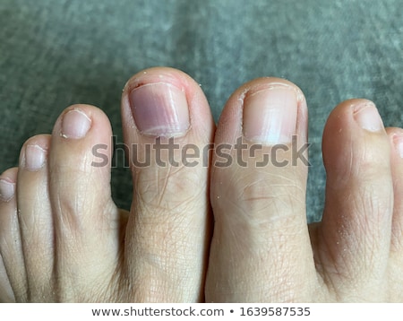 Сток-фото: Subungual Hematoma Under Nail