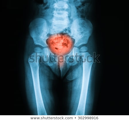 Foto stock: Human Anatomy Of Urinary Tract Infection