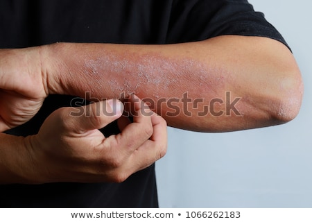 Foto stock: Eczema Closeup