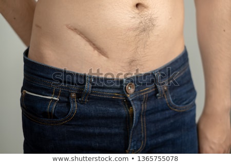 Foto stock: Medicine Appendectomy Surgery Scar