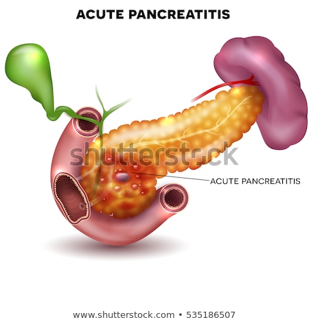 Stock photo: Pancreatitis Illustration Inflammation Of Pancreas And Other Su