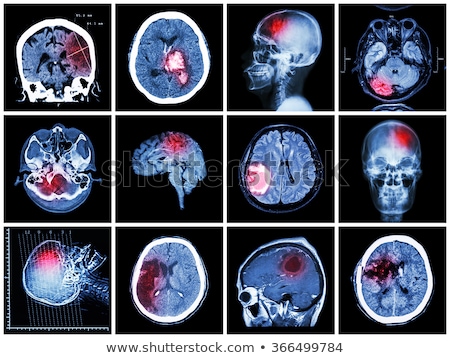 Stockfoto: Cerebral Hemorrhage Diagnosis Medical Concept