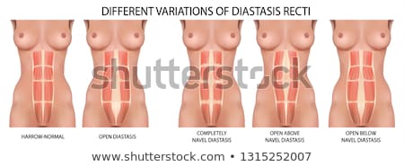Stok fotoğraf: Diastasis Recti Or Abdominal Separation