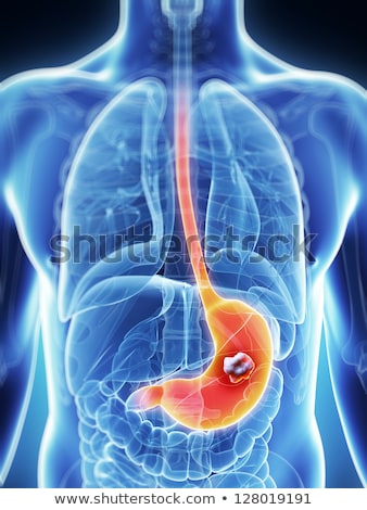 Stock photo: 3d Rendered Illustration Of The Male Stomach - Cancer