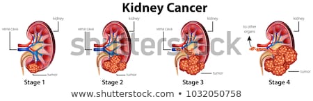 Stock foto: Kidney Cancer Disease