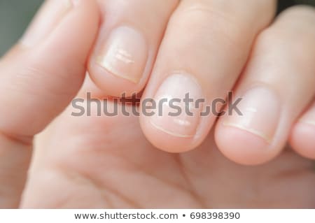 Stok fotoğraf: Nail Disease - Medical Concept