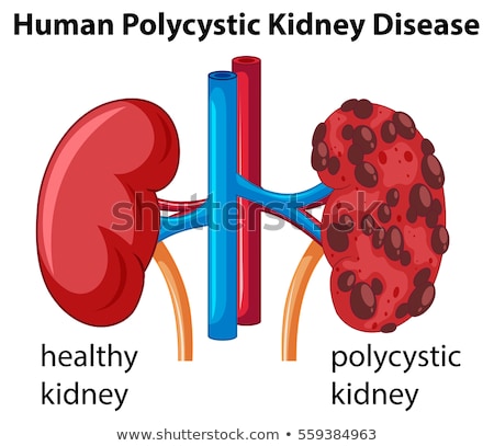 Stock photo: Diagram Showing Human Polycystic Kidney Disease