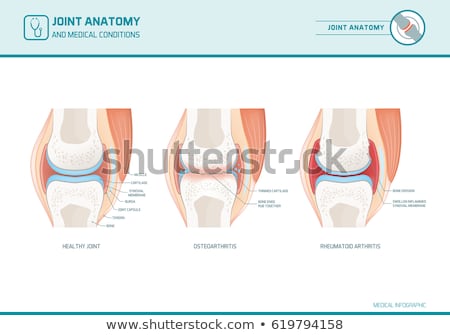 Stok fotoğraf: Osteoarthritis And Normal Joint