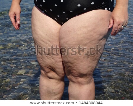 Foto stock: Cellulite And Obesity