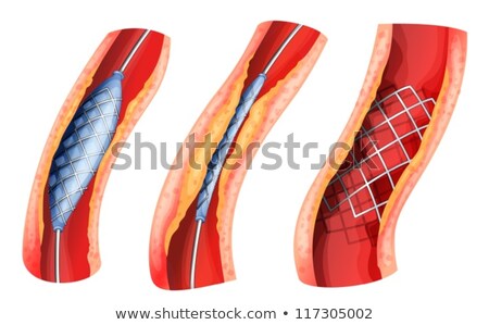 Stock foto: Stent Used To Open Blocked Artery