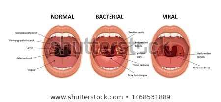 [[stock_photo]]: Viral Tonsillitis