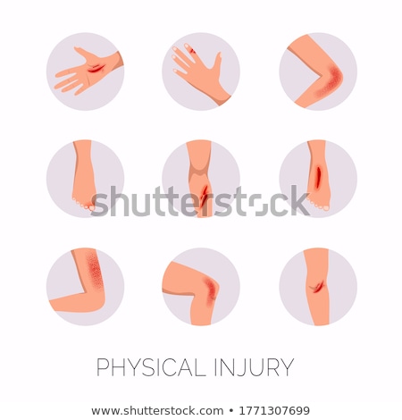 Foto stock: Bruised Arm