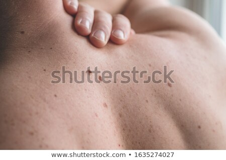 Foto stock: Close Up Of A Doctor Checking Pigment Skin On Mans Back