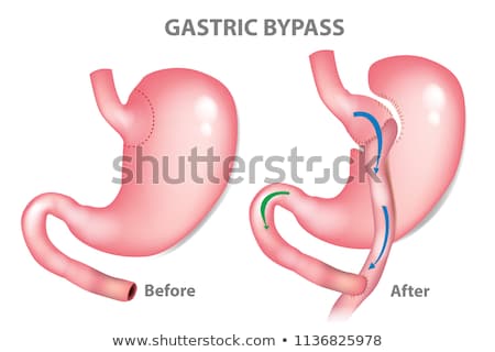 Foto stock: Gastric Bypass