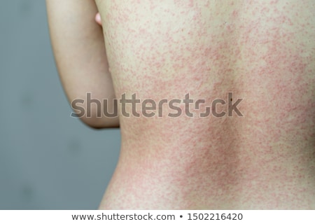 ストックフォト: Allergic Rash Dermatitis