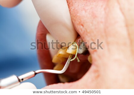 Foto d'archivio: Dental Cord Placing In Gingival Sulcus