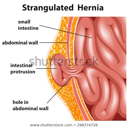 [[stock_photo]]: A Human Anatomy Strangulated Hernia