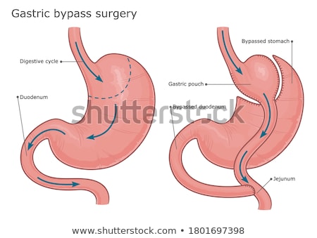 Foto stock: Gastric Bypass Scheme