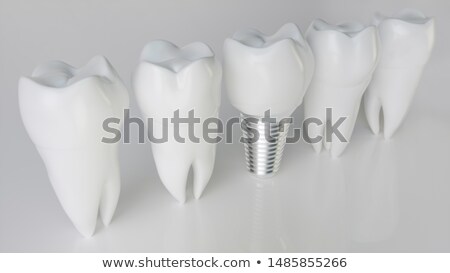 Foto stock: Dental Tooth Implant