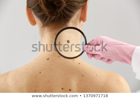 Сток-фото: Melanoma Or Skin Cancer