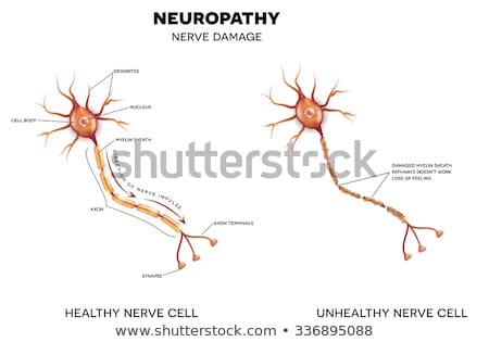 Stock fotó: Neuropathy Nerve Damage