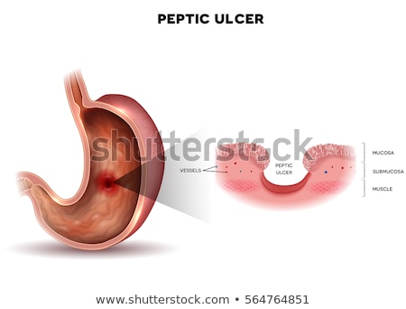 Сток-фото: Peptic Ulcer Of The Stomach Microscopic Colorful Anatomy On A W