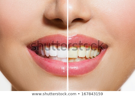 Foto d'archivio: Woman Teeth After Whitening Happy Smiling Woman Dental Health Concept Oral Care Beautiful White